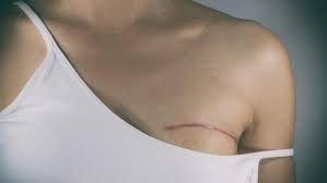 cicatrices de réduction mammaire