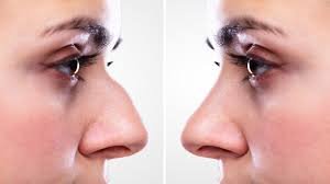 résultat rhinoplastie