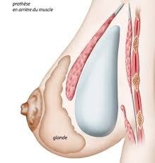 augmentation mammaire par implants mammaires